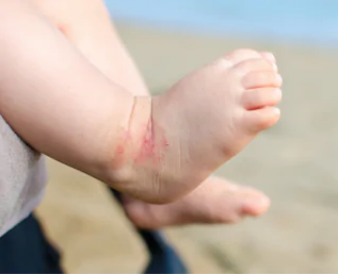 WHAT IS HISTAMINE? HOW CAN IT PLAY A ROLE WITH CHILDREN ECZEMA?